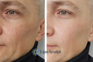 How to Fight Aging Symptoms 3 Fight Aging Symptoms Stourport on Severn With HIFU and Morpheus8 Today!
