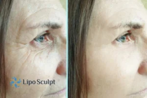 How to Fight Aging Symptoms 2 Do you want to Fight Aging Symptoms Stourport on Severn? Contact Lipo Sculpt today!