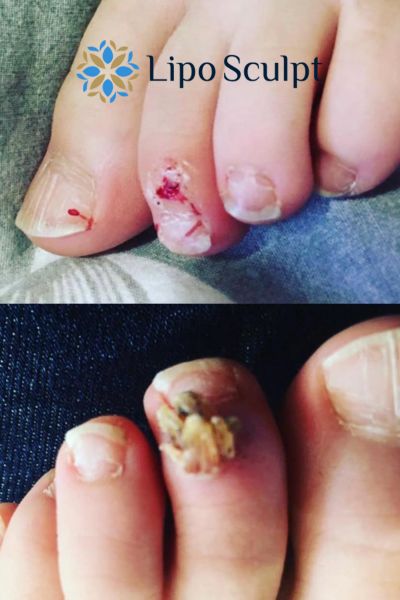 Wart removal customer results from Lipo Sculpt Stourport on Severn
