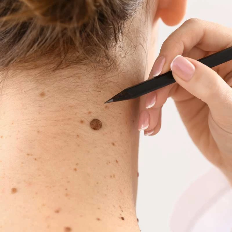 How to Support Your Body During Pregnancy for Faster Postnatal Recovery 5 See our lesion removal prices Stourport on Severn - call today for a free quote